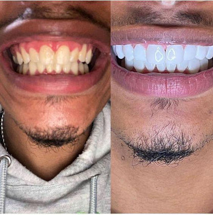 🖤 Charbon Blanchisseur de Dents – Sourire Plus Éclatant en Quelques Minutes
